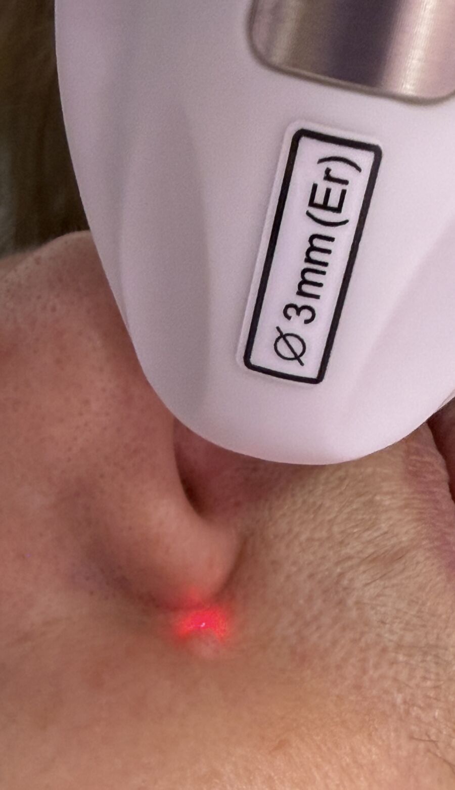 Obrázok ukazuje odstránenie bradavice, wart treatment
